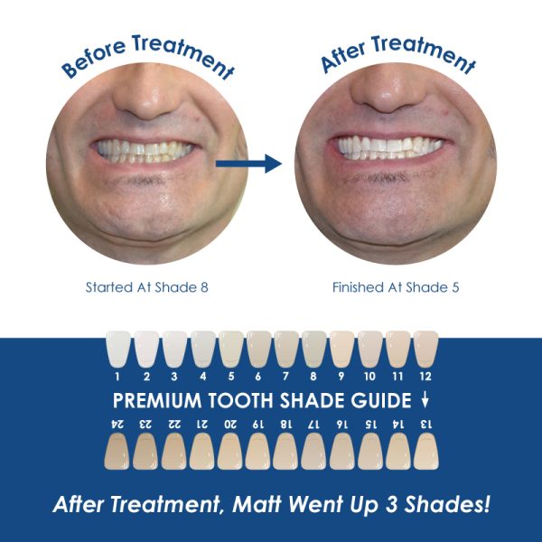 Whiter Image - Products - White Blitz Premium Prefilled Whitening Kit 07