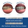 Whiter Image - Products - iBrite LED Whitening Light 07