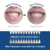Whiter Image - Products - Whiter Image Mouth Tray with Case 07