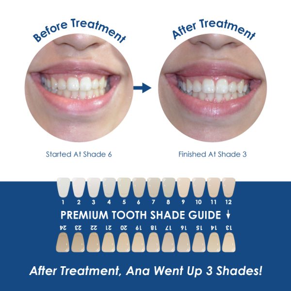 Whiter Image - Products - Whiter Image Mouth Tray with Case 07