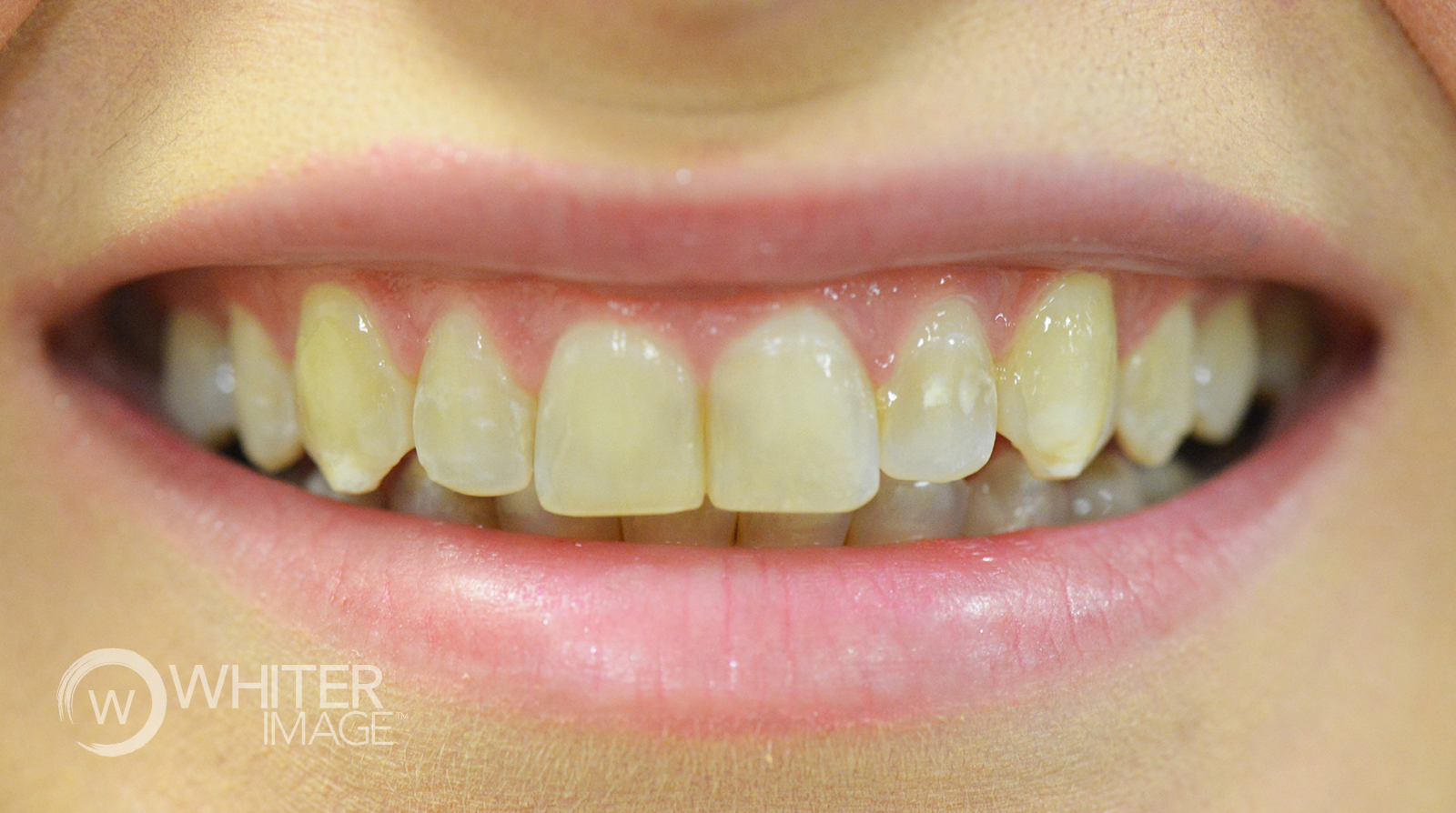 Whiter Image - Before Image
