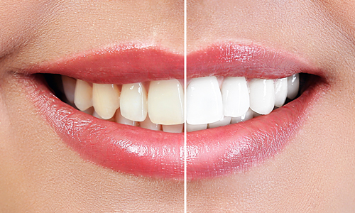 Whiter Image - Why Choose Us - Clinically Proven